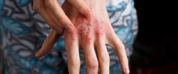 Kardiovaskulární komorbidity u atopické dermatitidy